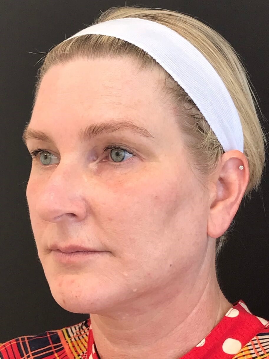 Mid and lower face treatment After