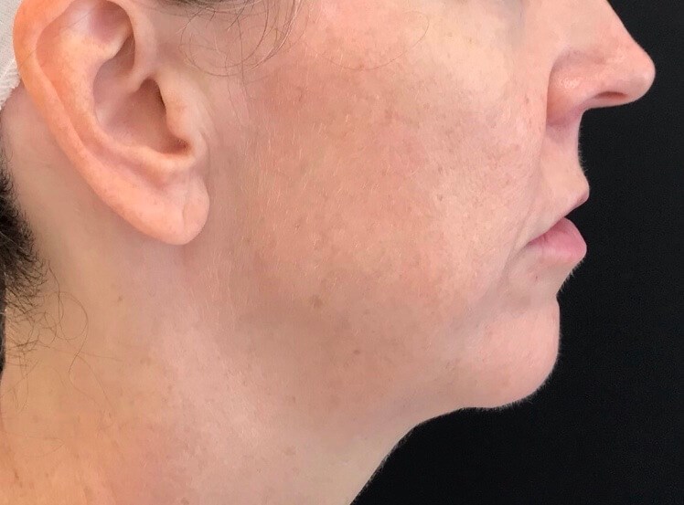 Lower Face Enhancement Before