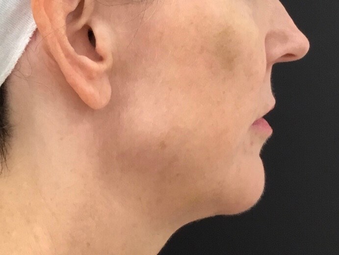 Lower Face Enhancement After