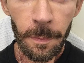 Enhance Cheek Volume Before