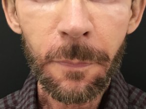 Enhance Cheek Volume After