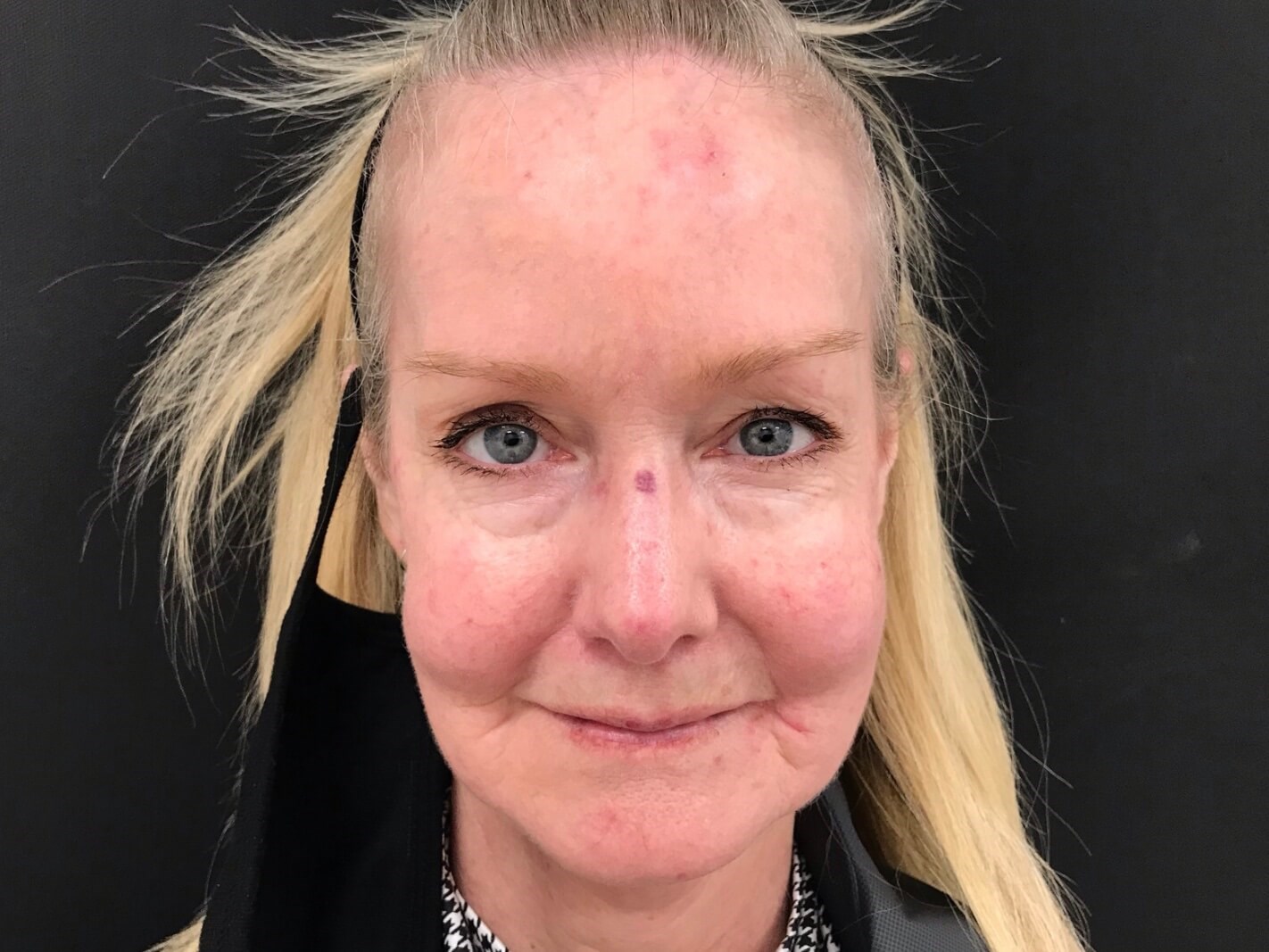 Laser Treatment for Redness Before