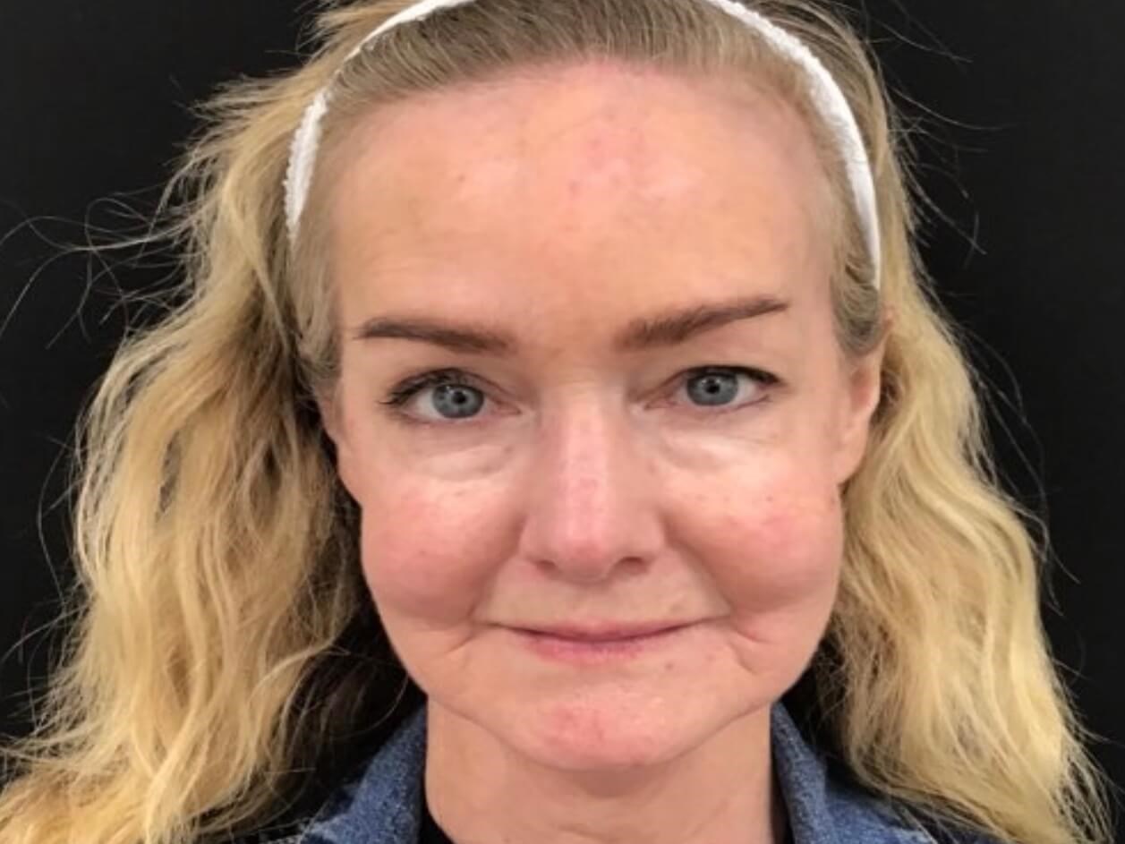 Laser Treatment for Redness After