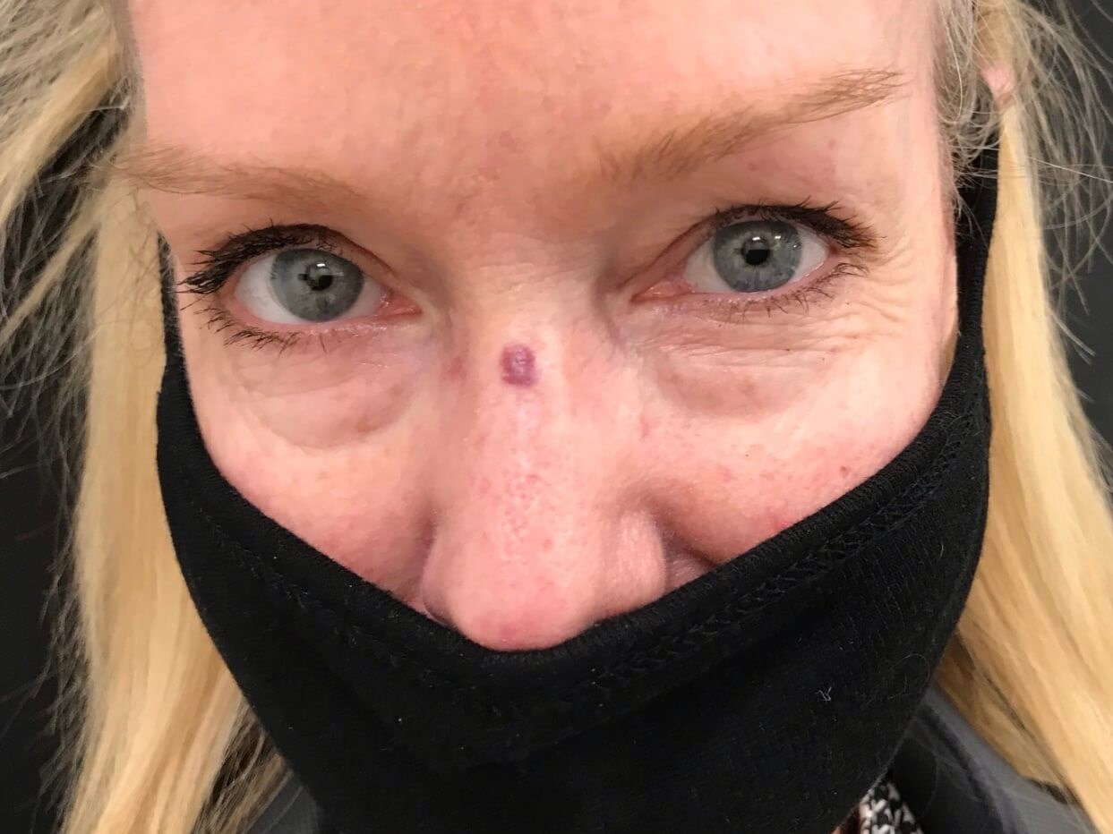 Laser Treatment for Hemangioma Before