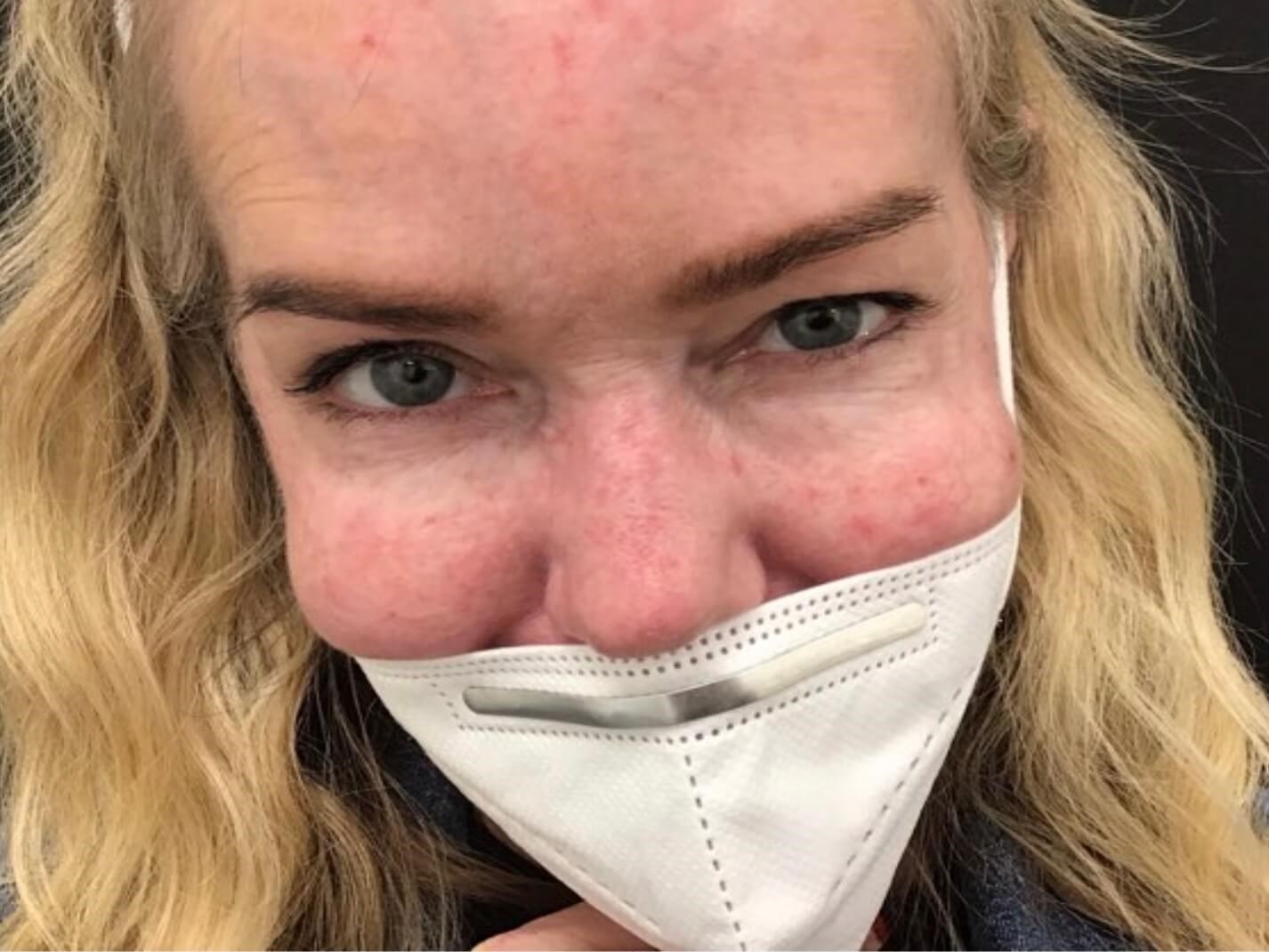 Laser Treatment for Hemangioma After