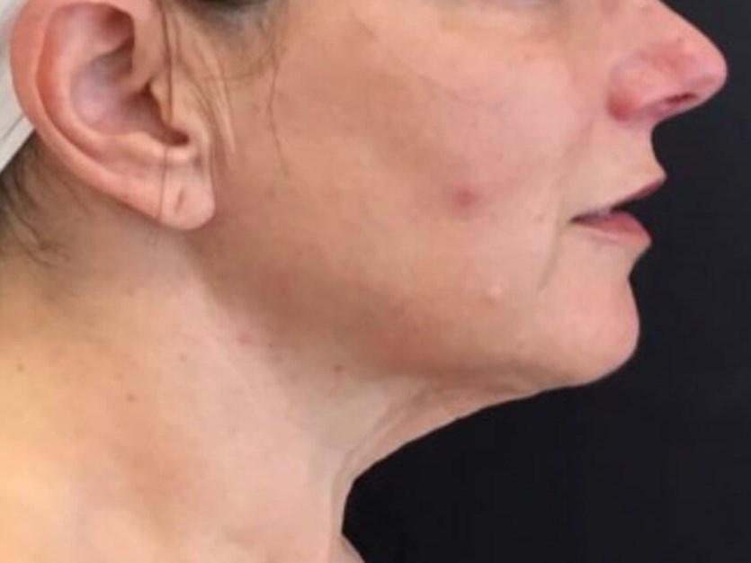 Non-surgical Skin Tightening Before