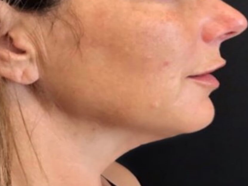 Non-surgical Skin Tightening After