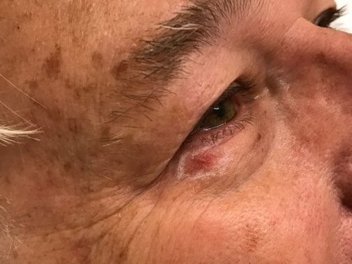 Mohs for Basal Cell Below Eye Area of Concern Identified