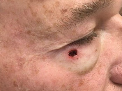 Mohs for Basal Cell Below Eye Mohs Excision