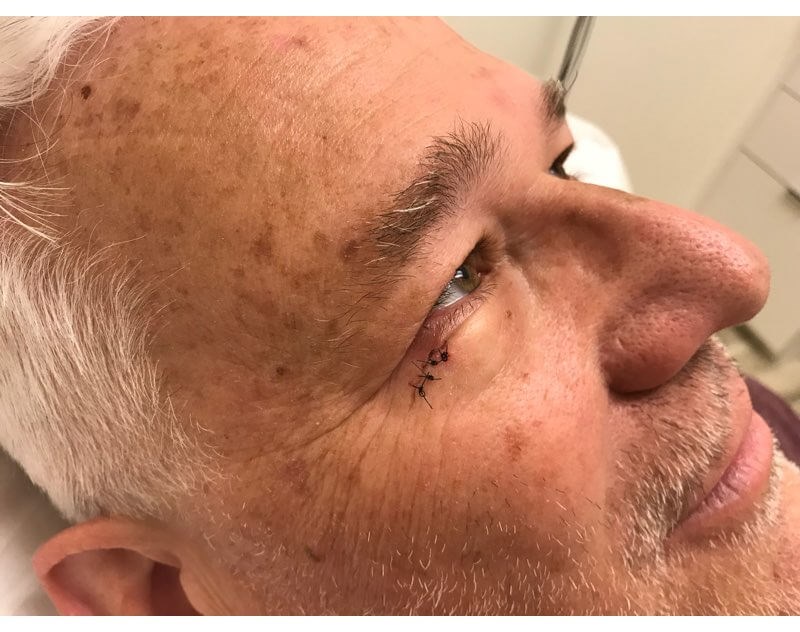 Mohs Surgery Sutures & Healing 1 Week after Surgery