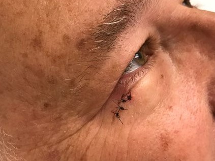 Mohs Surgery Sutures & Healing 1 Week after Surgery