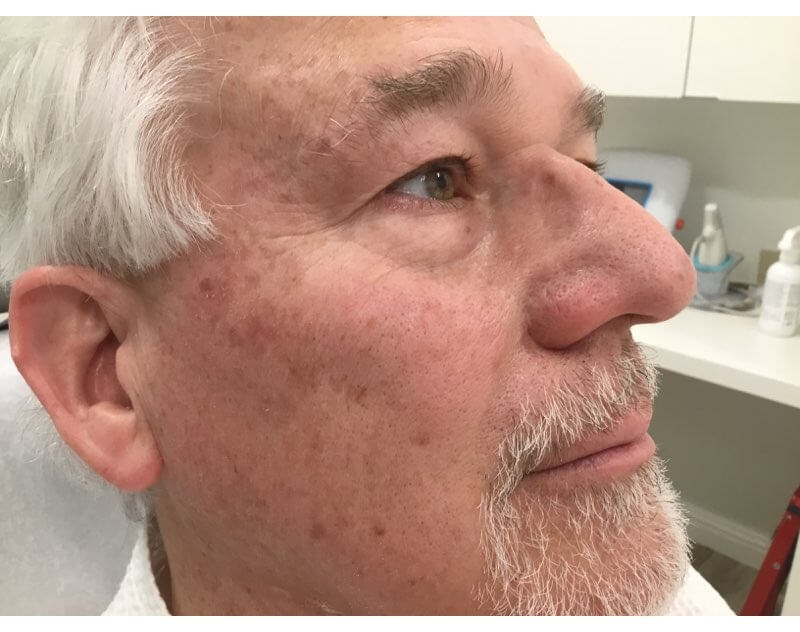 Mohs Surgery Sutures & Healing 2 Years Post Surgery