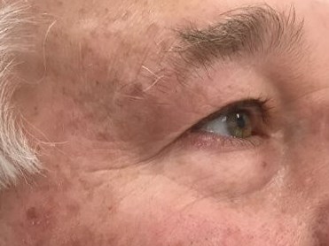 Mohs Surgery Sutures & Healing 2 Years Post Surgery