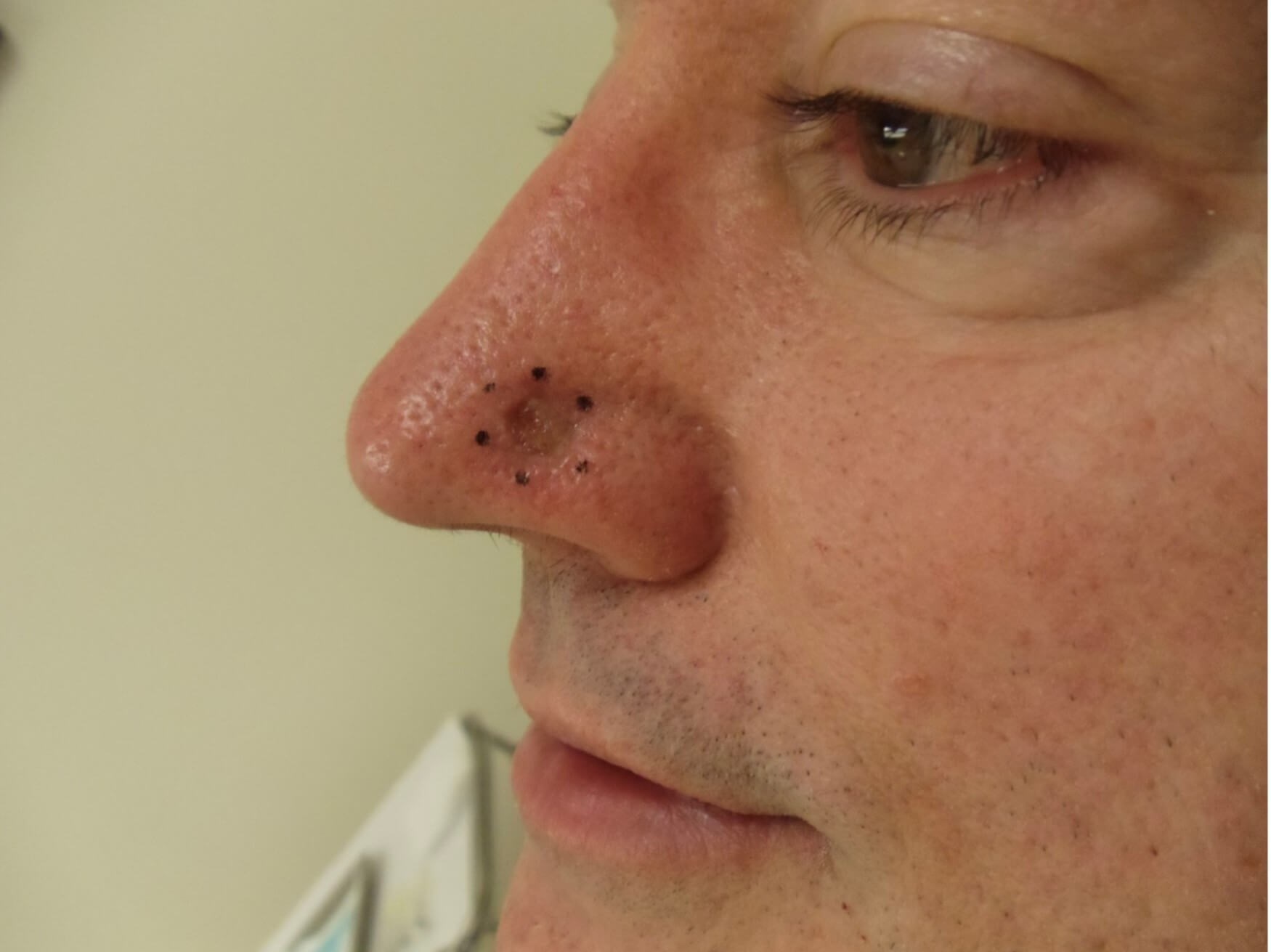 Skin Cancer Detection Biopsy After