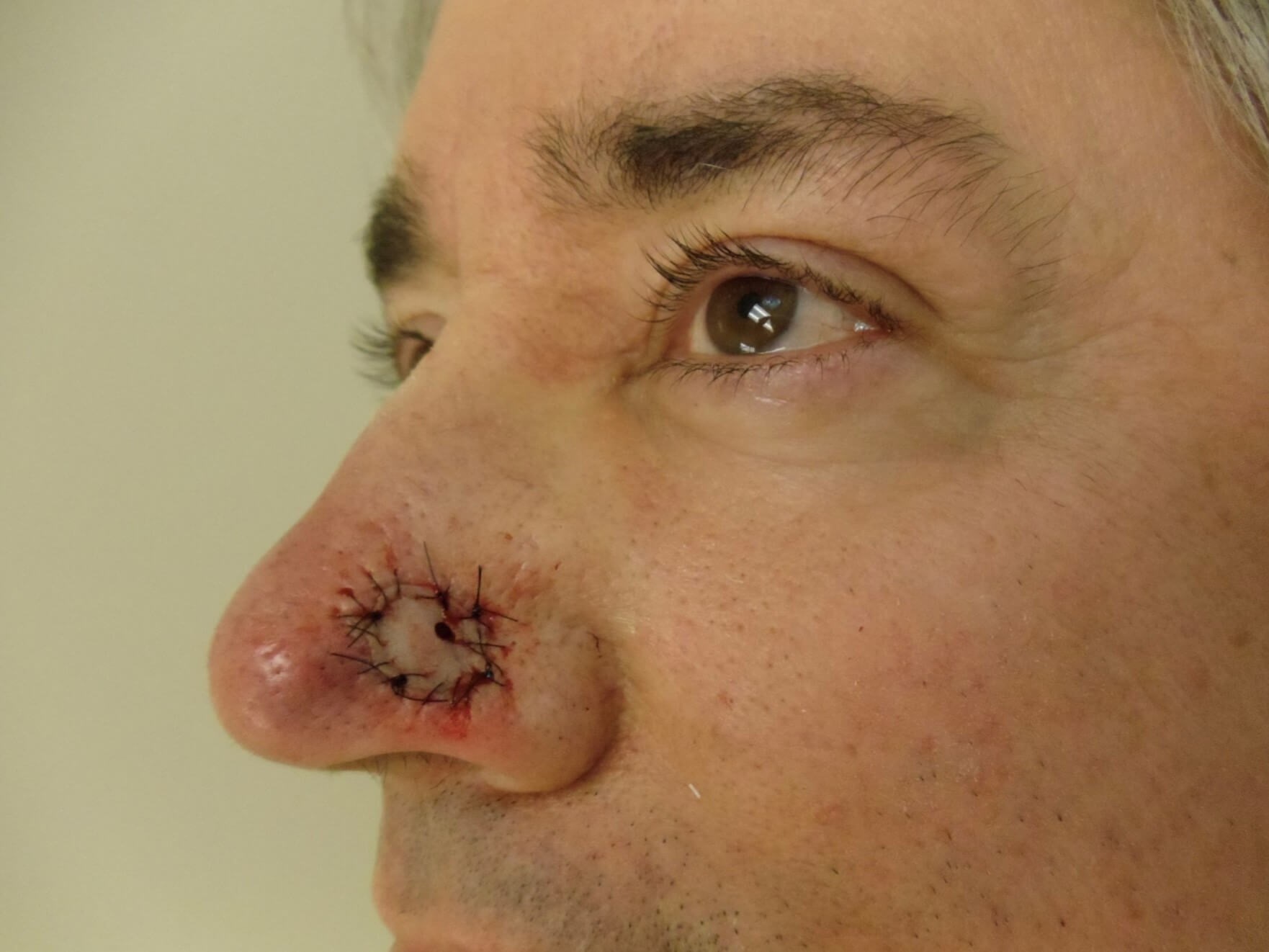 Mohs Surgery, graft, nose Before