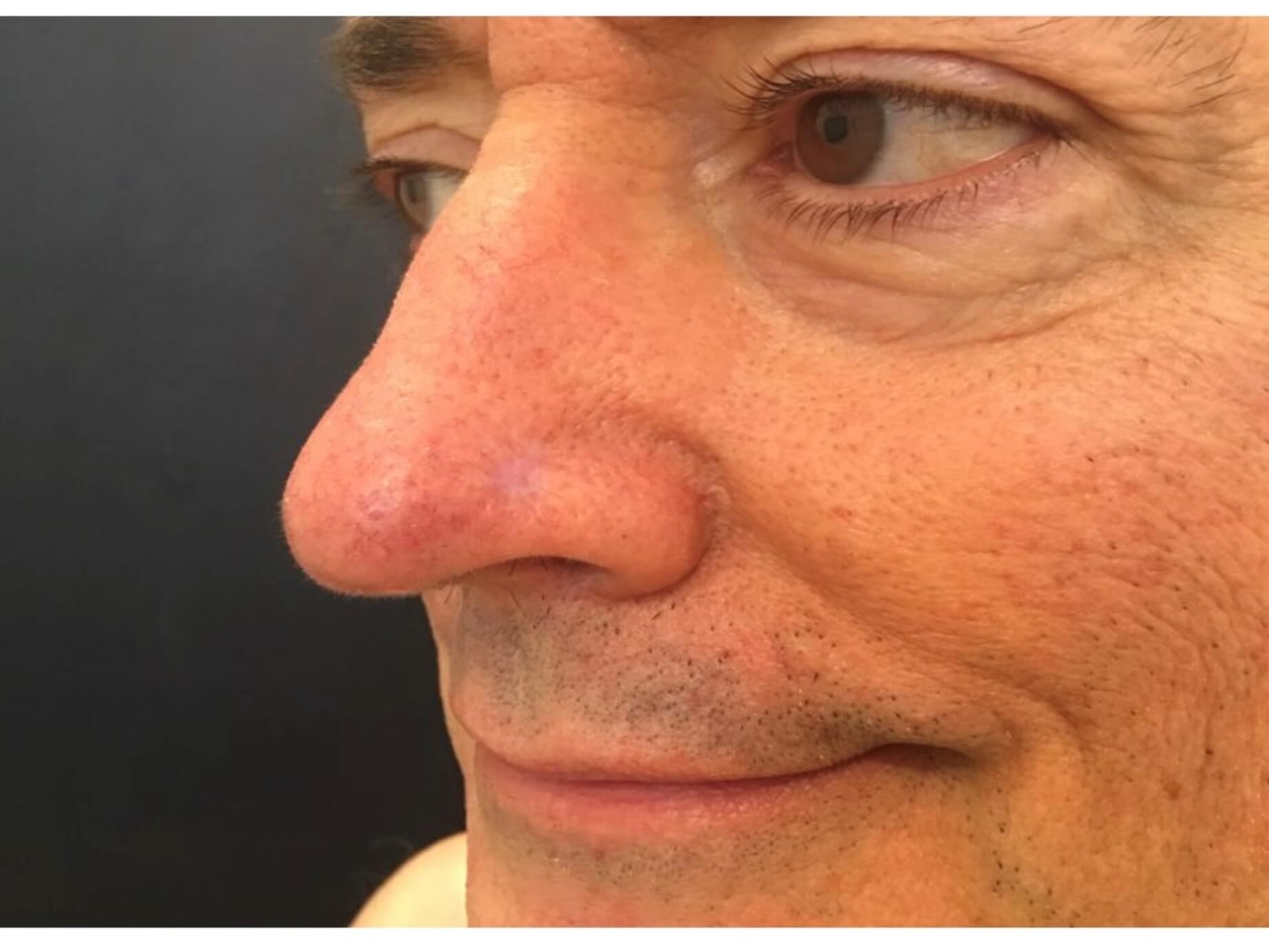 Mohs Surgery, graft, nose After