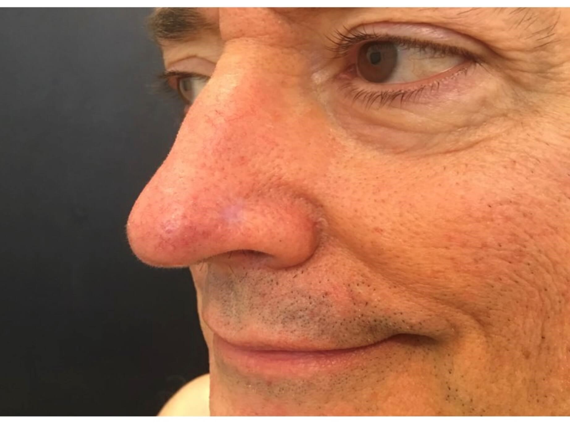 Mohs Surgery, graft, nose After