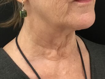 Neck and Jowls Treatment Before