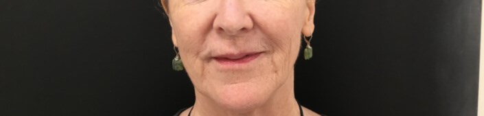 Reduce Smile Lines Before