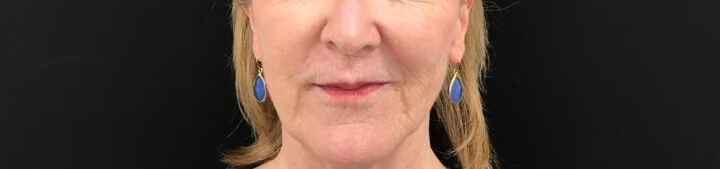 Reduce Smile Lines After