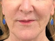 Reduce Smile Lines After