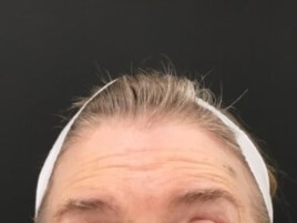 Decrease Forehead Lines Before