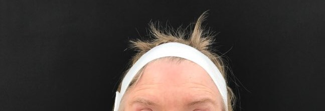 Decrease Forehead Lines After