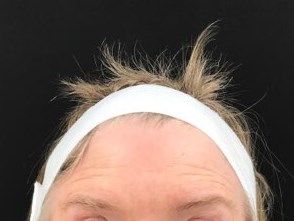 Decrease Forehead Lines After