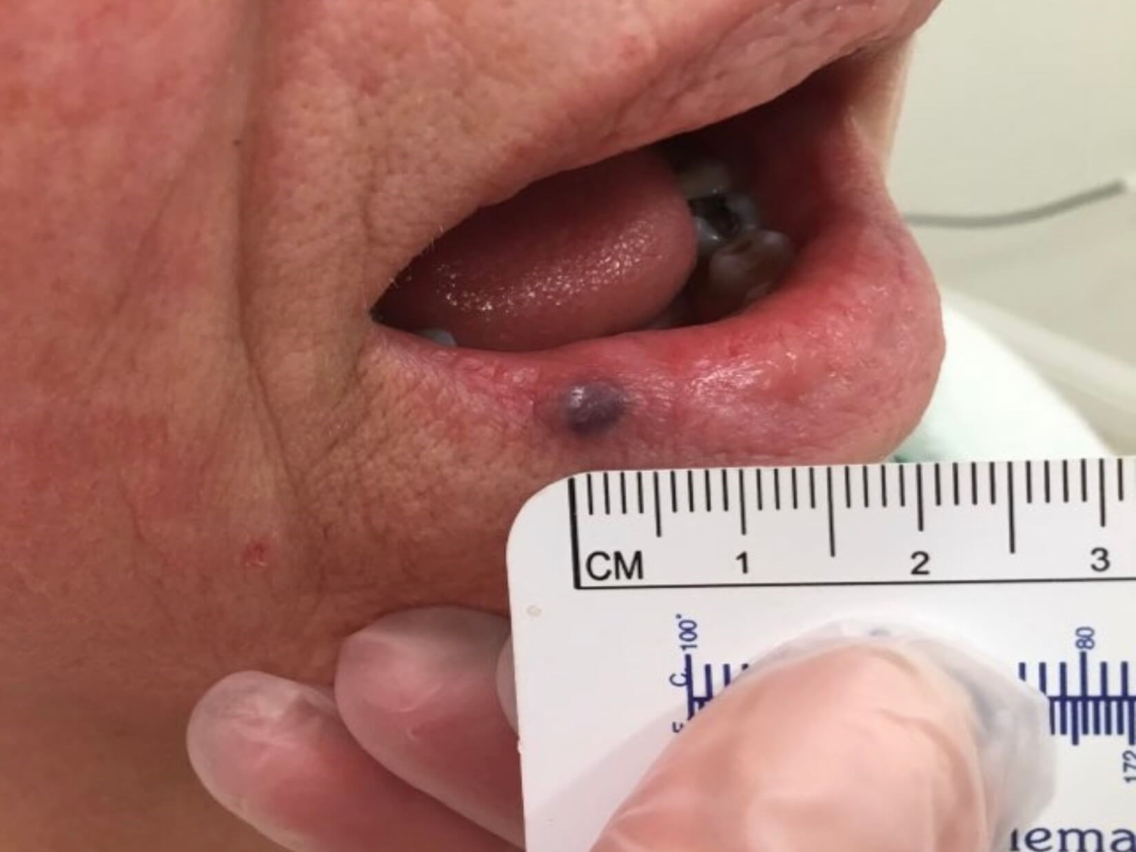 Laser Therapy for Venous Lake Before