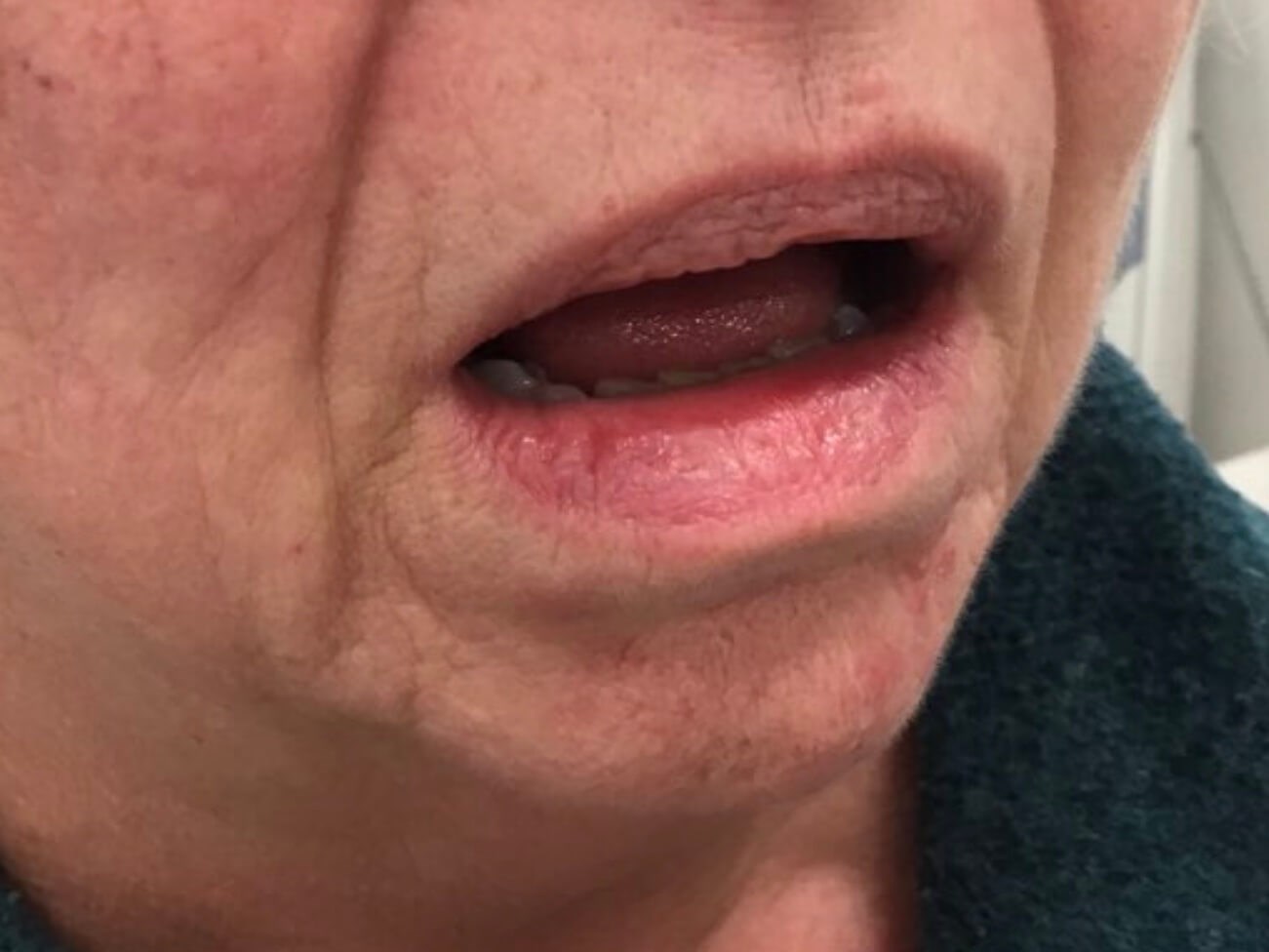 Laser Therapy for Venous Lake After