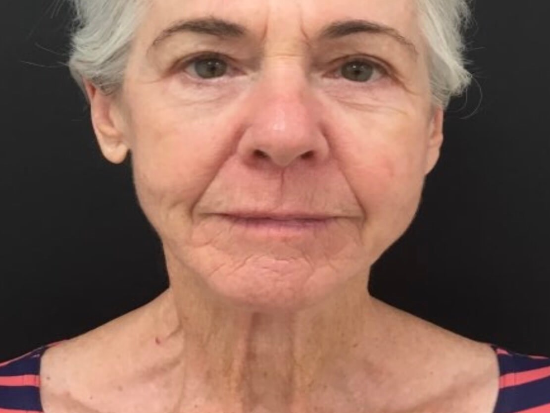 Lower Face Rejuvenation Before