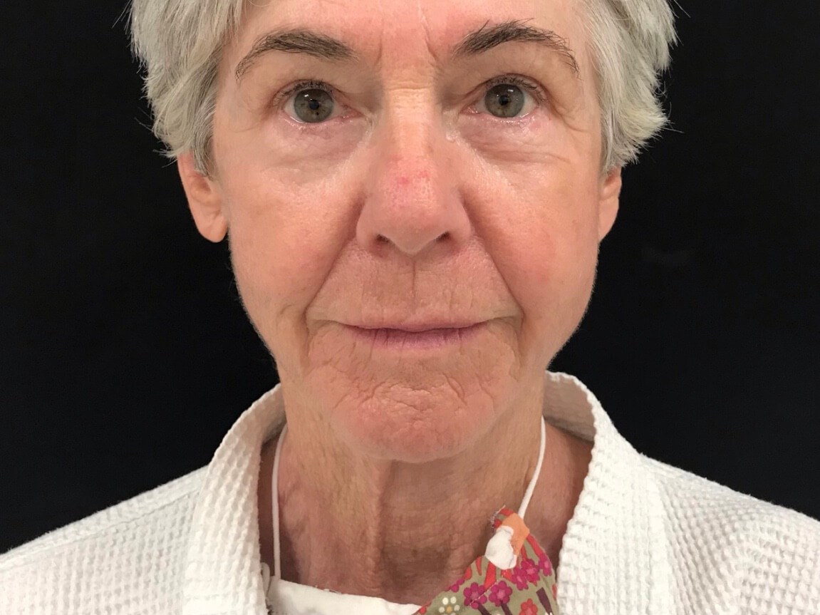 Lower Face Rejuvenation After