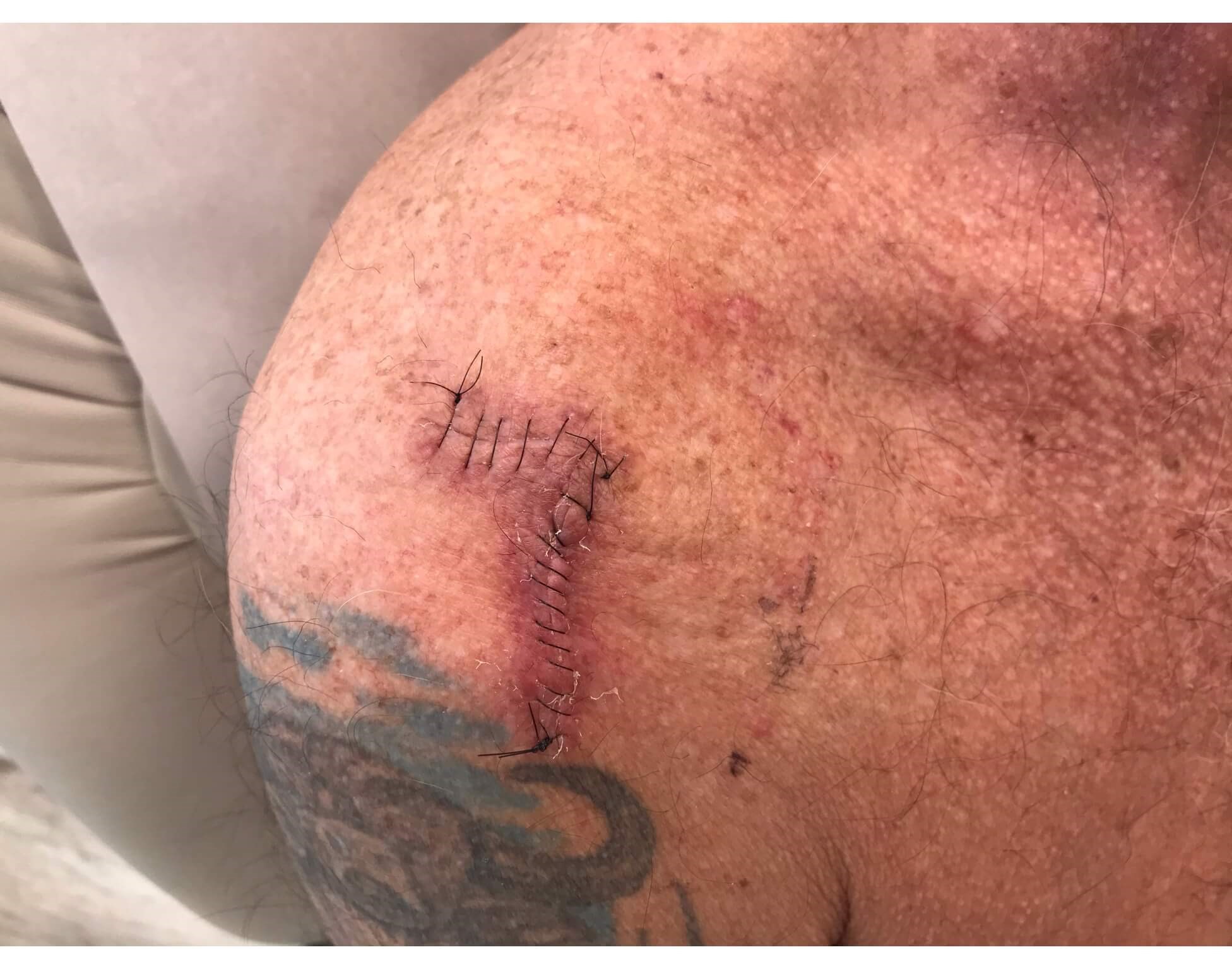 Mohs Surgery Scar Healing Before