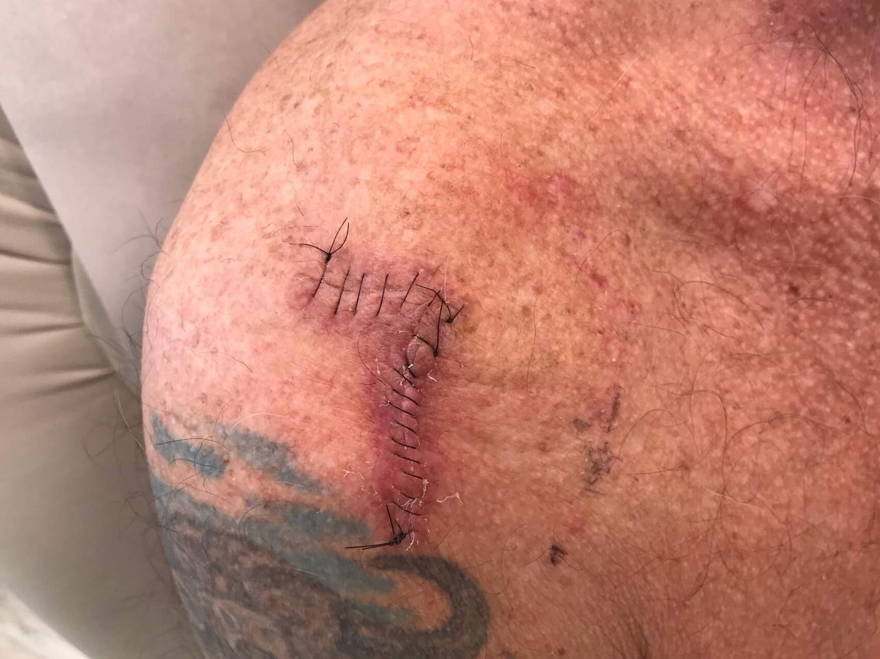 Mohs Surgery Scar Healing Before