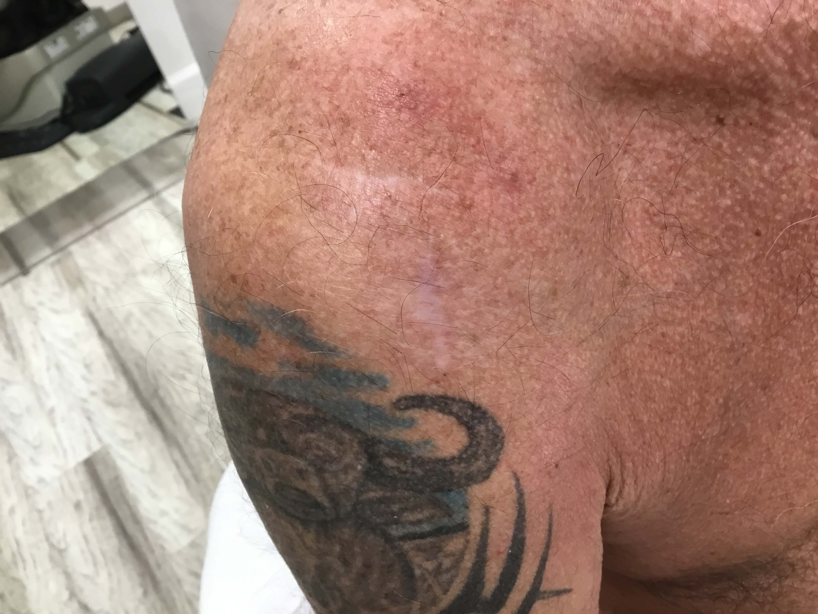 Mohs Surgery Scar Healing After