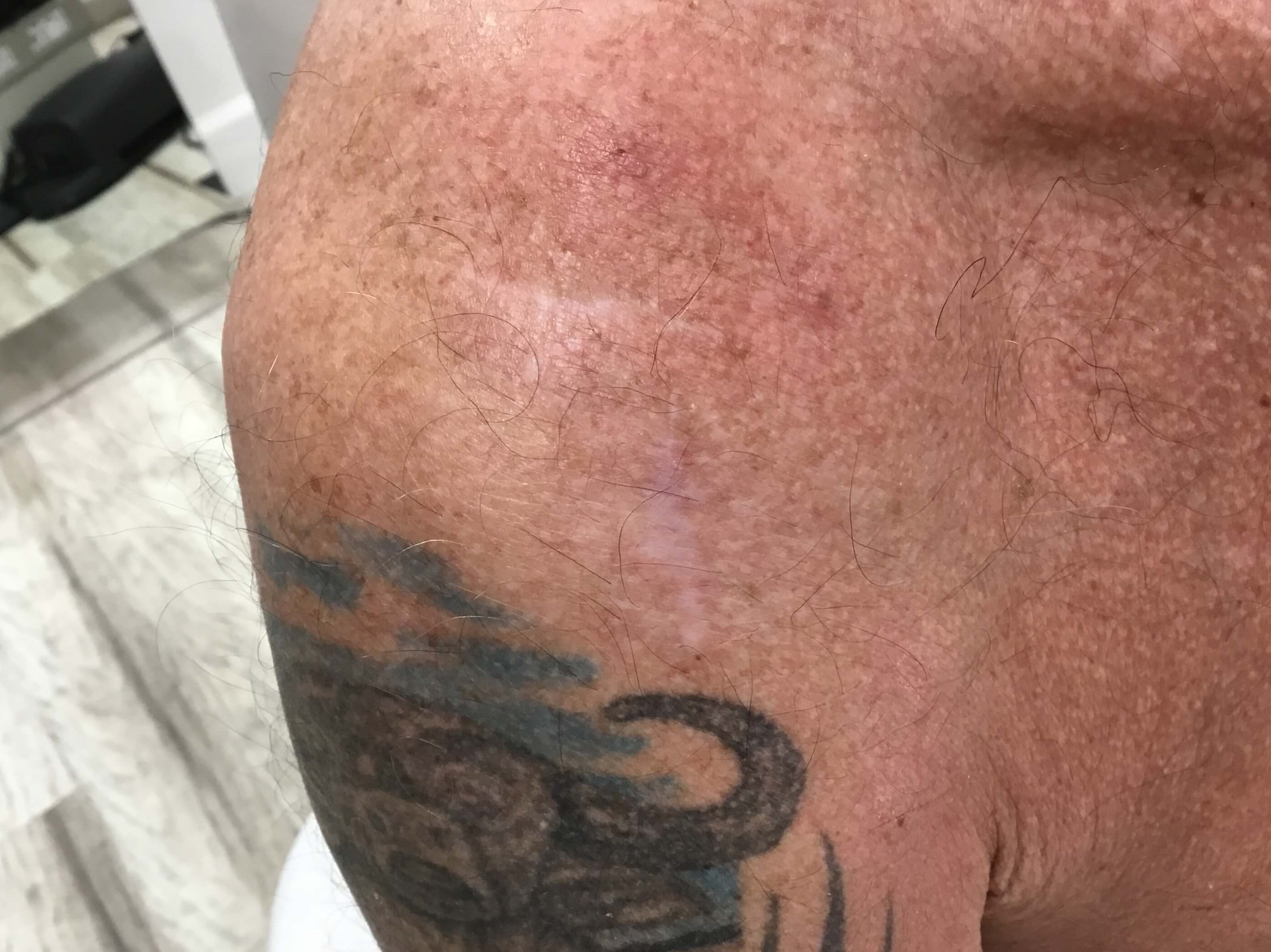 Mohs Surgery Scar Healing After