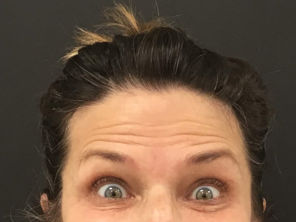 Botox for forehead wrinkles Before