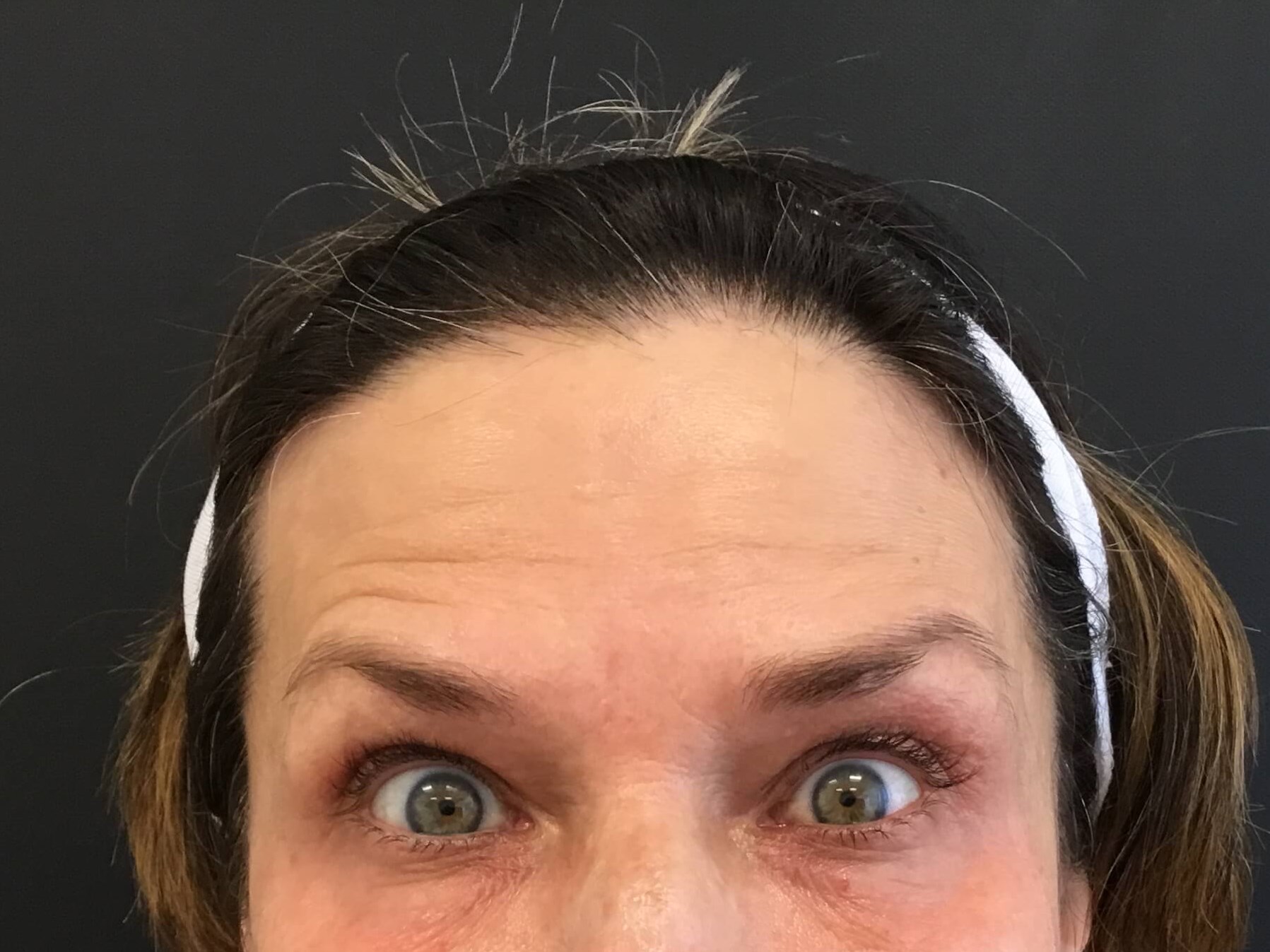 Botox for forehead wrinkles After