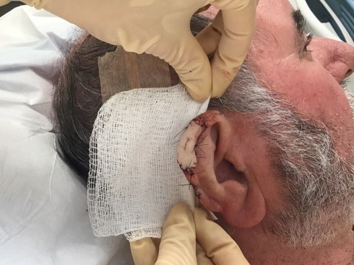 Mohs Surgery with Skin Graft Before