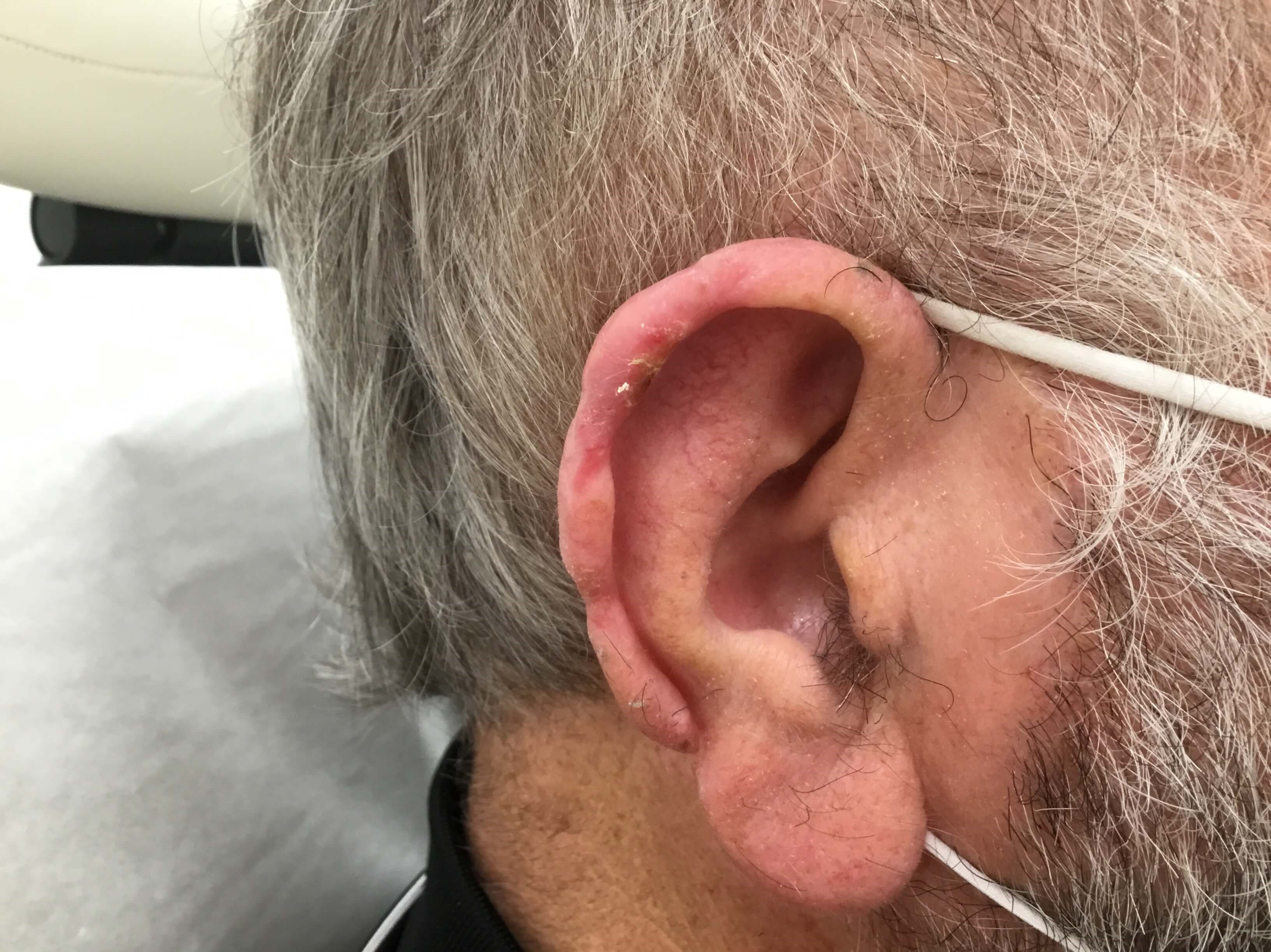 Mohs Surgery with Skin Graft After