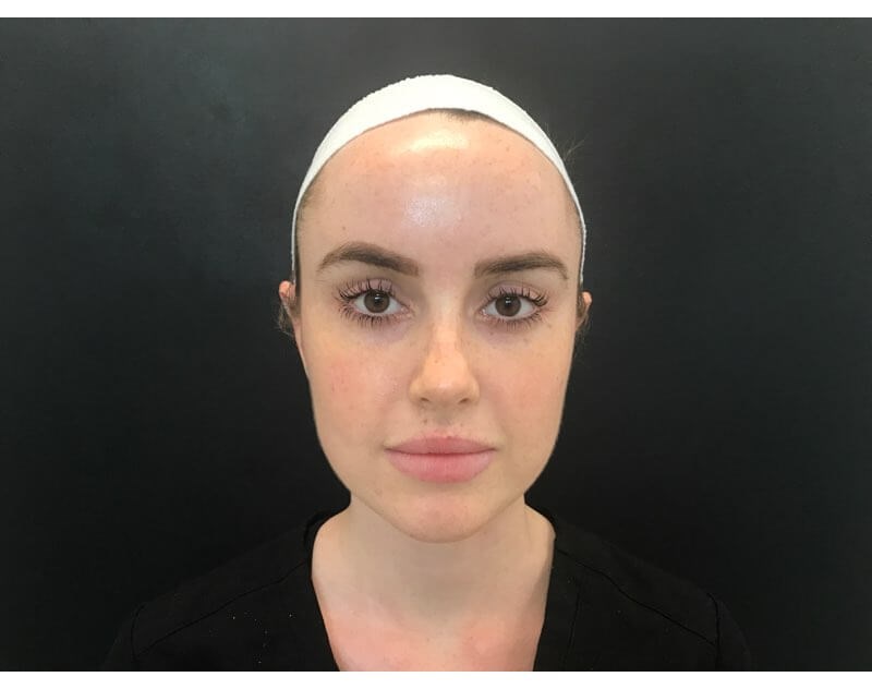 Facial Slimming Treatment Before