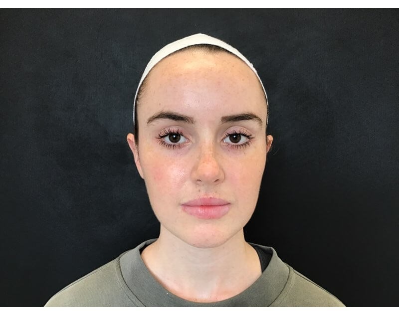 Facial Slimming Treatment After