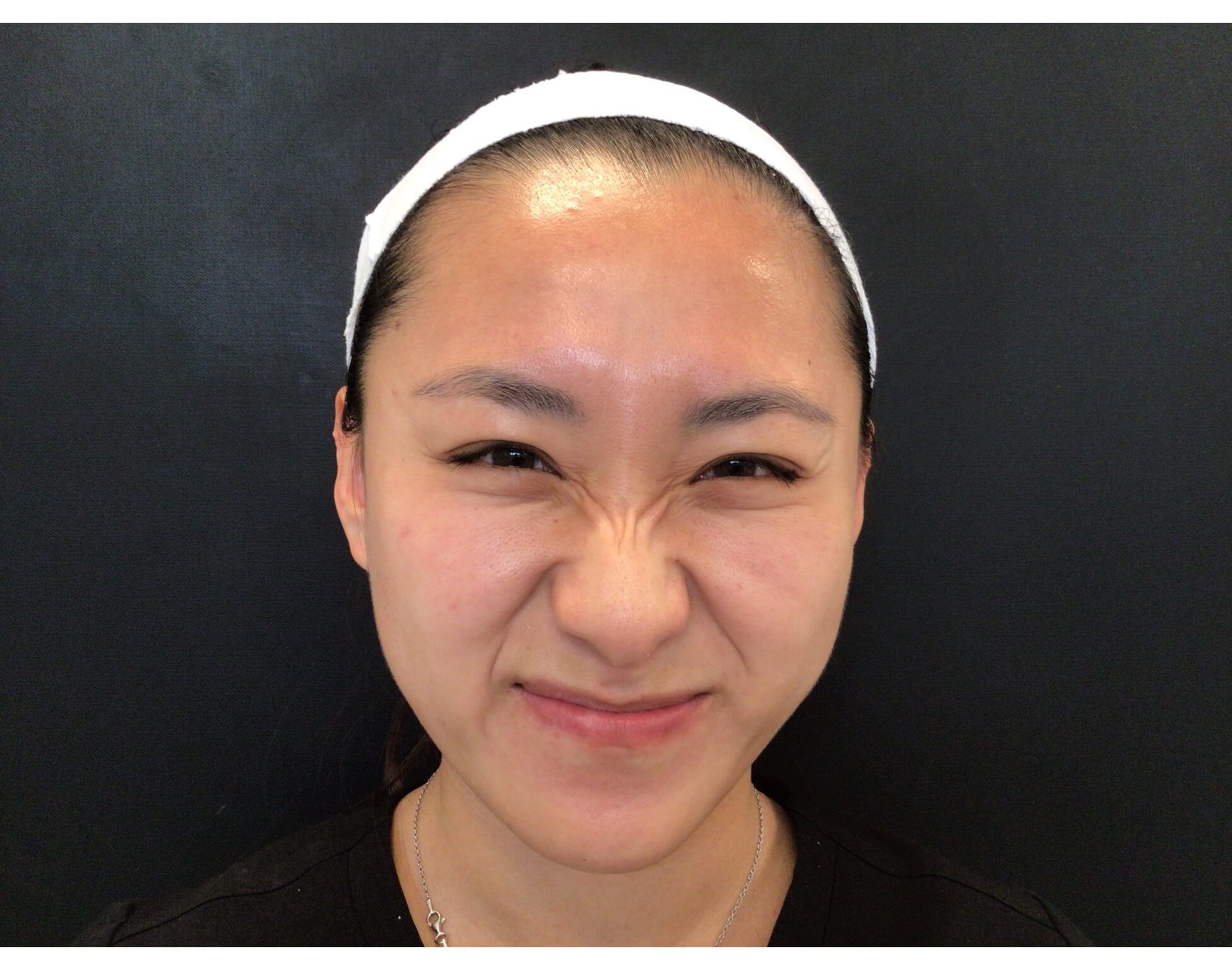 Xeomin for Bunny Lines Before