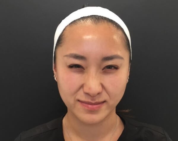 Xeomin for Bunny Lines After