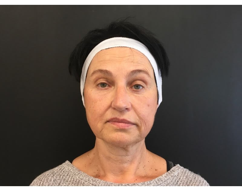 Filler for Mid Face Before