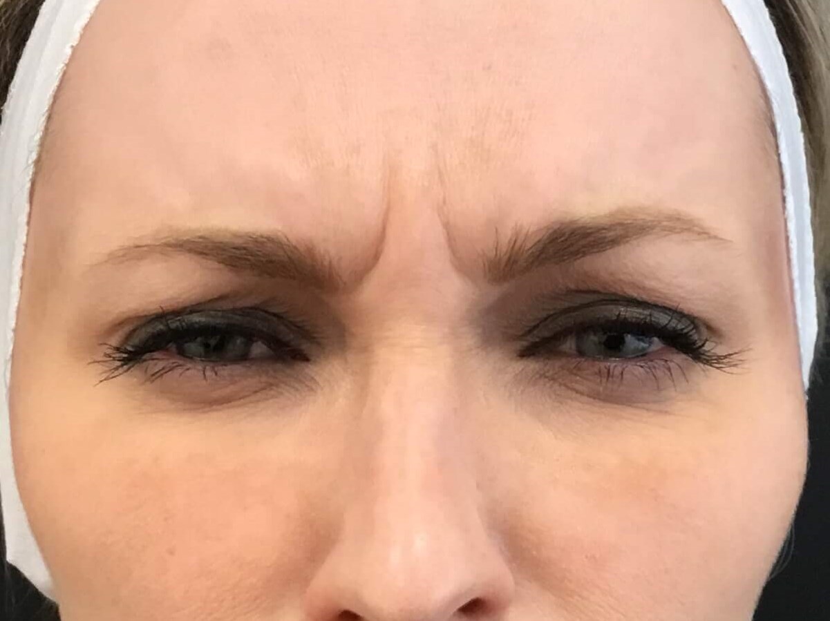 Botox for Frown Lines Before