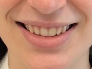 Xeomin for Lip Flip Before