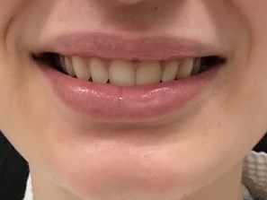 Xeomin for Lip Flip After