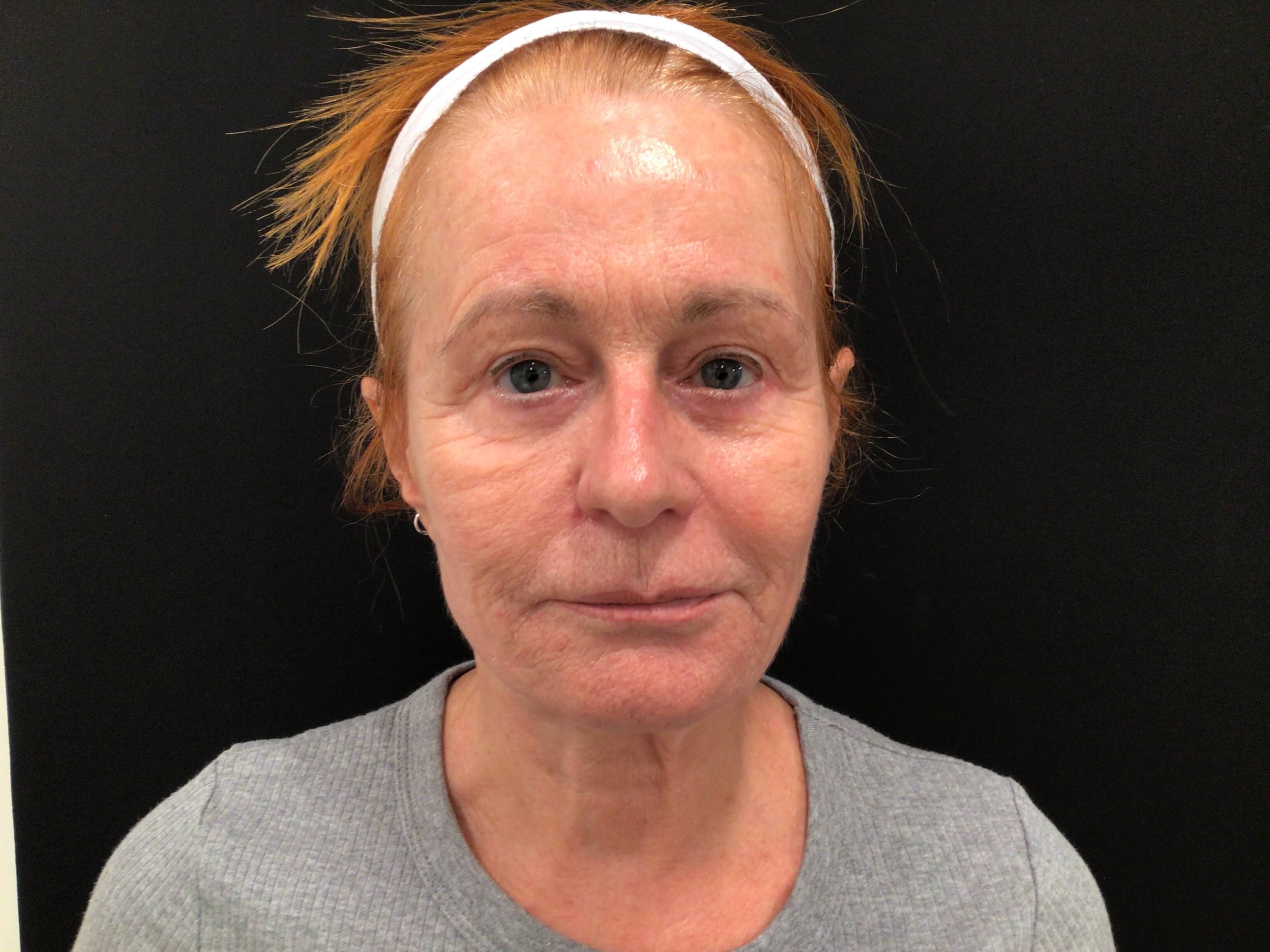 Nasolabial Fold Rejuvenation Before