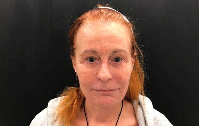 Nasolabial Fold Rejuvenation After